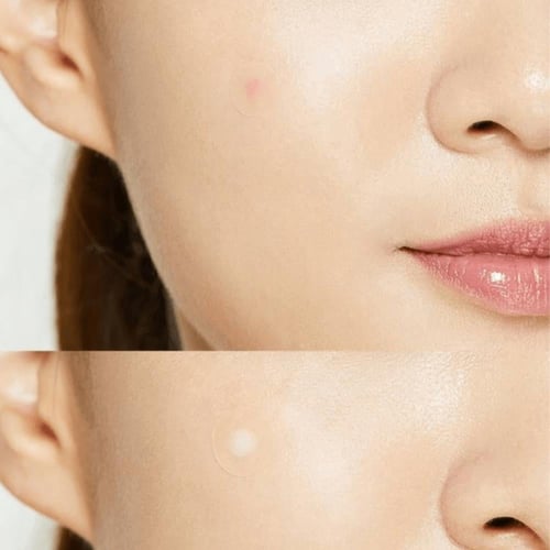 لصقات حب الشباب من كوسركس - 24 حبه