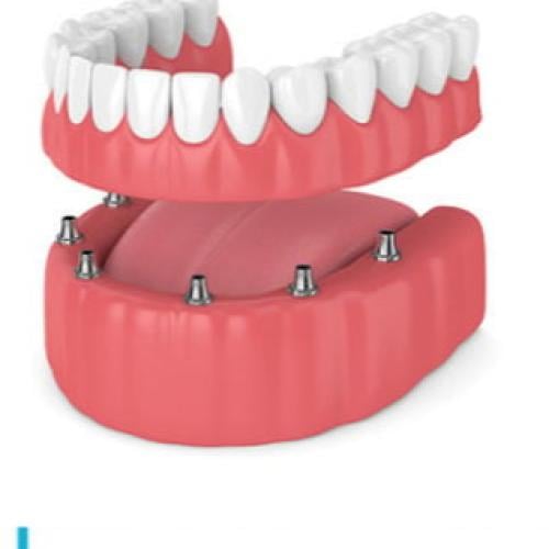 285 . طقم كامل فوق الزرع سفلي مدعم بشريط زراعة معد...