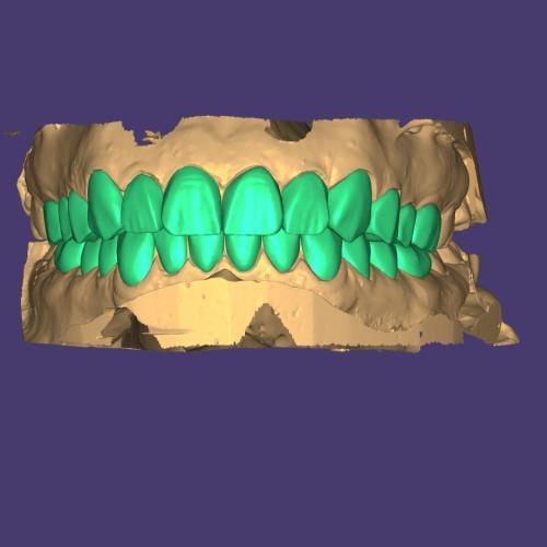 298. تصميم ابتسامة رقمية لفك واحد DSD for one Jaw