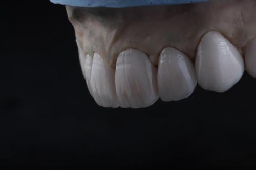 118 بكيج وجوه خزفية من الإيماكس 118 E.max veneers