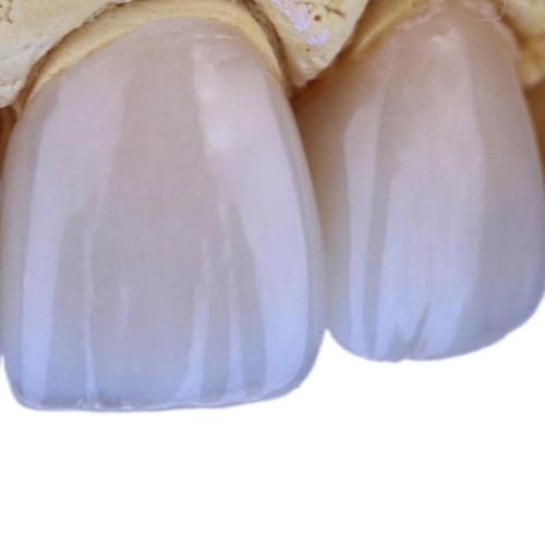 118 بكيج وجوه خزفية من الإيماكس 118 E.max veneers