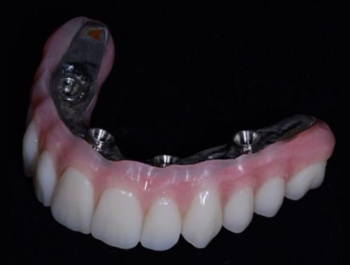 223 . هيكل معدني لزراعة الأسنان مع بناء الخزف وخزف...