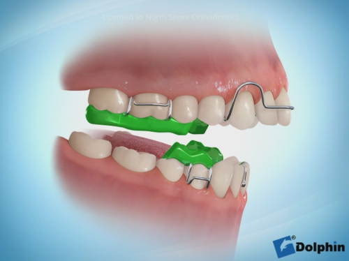 150. Twin block ortho appliance جهاز تقويم