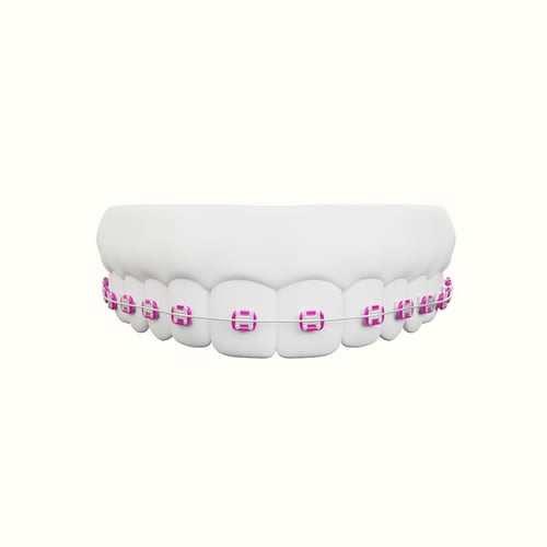 تقويم زينه فك منفصل بغراء