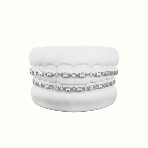 تقويم زينه فكين متصل بغراء