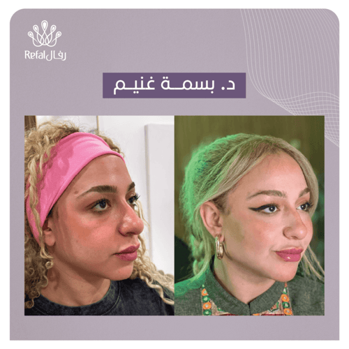 حقن الفيلر 1 مل