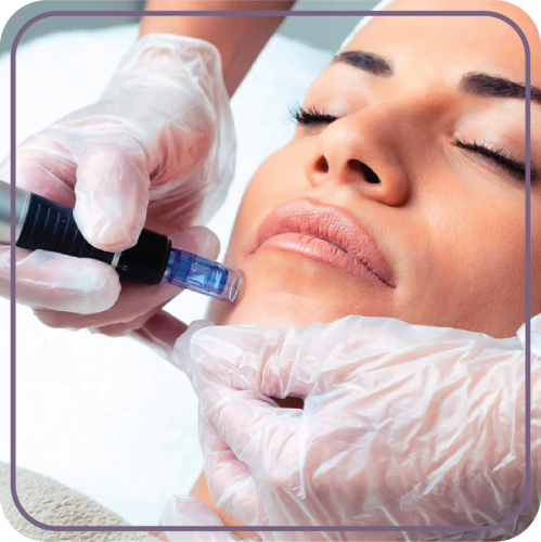 جلسة الديرما بن مع 1 مل ميزوثرابي (Derma Pen)