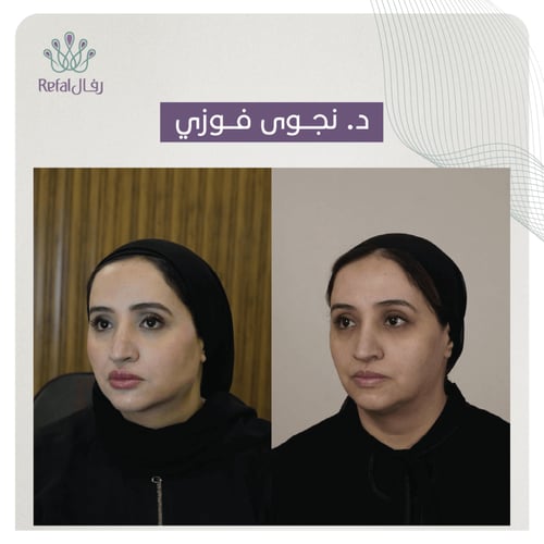 حقن الفيلر 1 مل