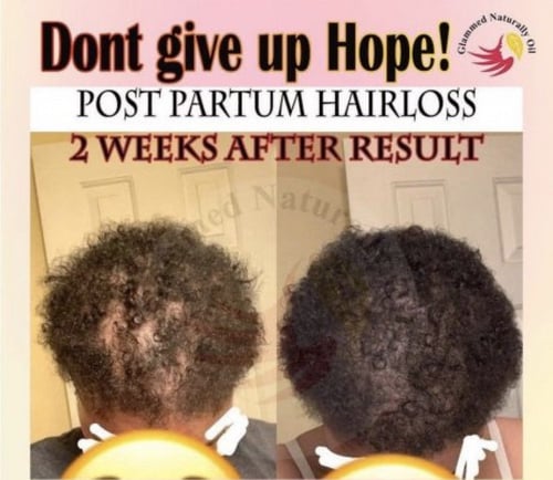 زيت التألق لتحفيز وتطويل الشعر والقضاء ع الفراغات...