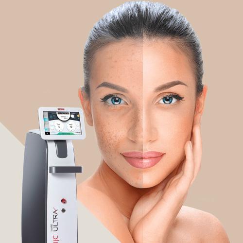 ألترا للندبات أو تجديد الوجه + الميزوثيرابي