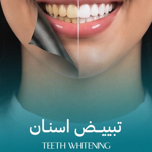 تبييض اسنان فكين - بالليزر