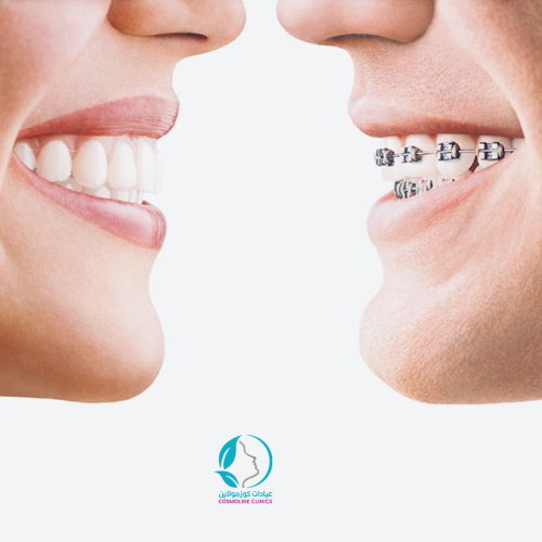 تقويم الاسنان حالة متوسطة