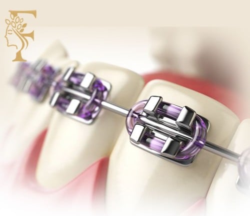 اعادة تركيب براكت