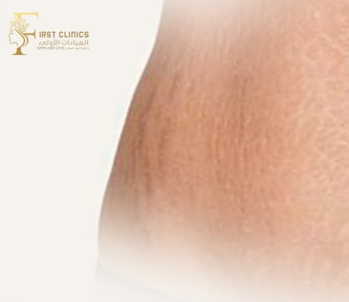 3 جلسات علاج علامات التمدد