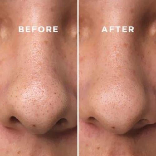 سيروم كوسركس مقشر للرؤوس السوداء بالنياسيناميد و B...