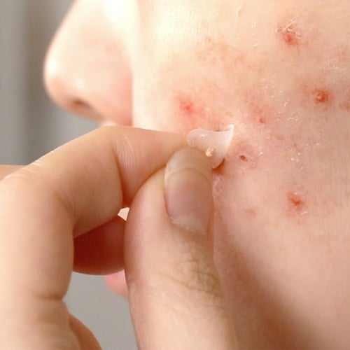 لصقات المعجزة لعلاج الحبوب والآثار من سوم باي مي