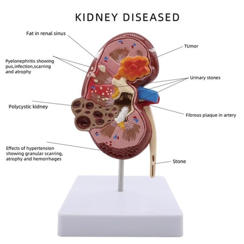 مجسم الكلية الطبيعي وأمراض الكلى