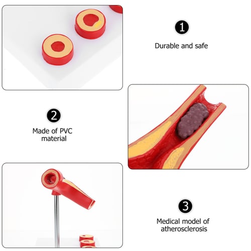 مجسم مراحل تصلب الشرايين