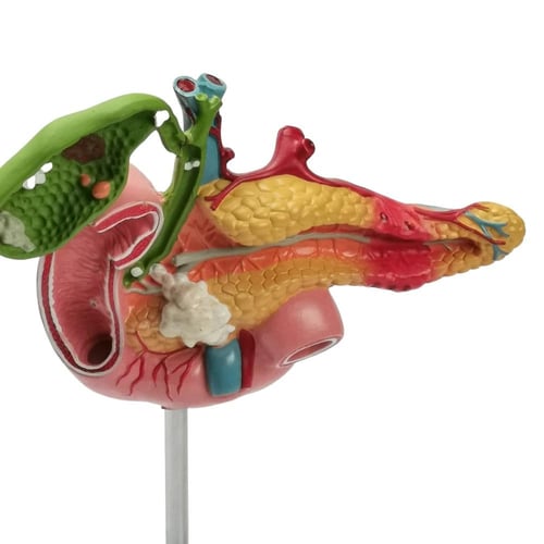 مجسم أمراض البنكرياس والمرارة والاثنين عشر