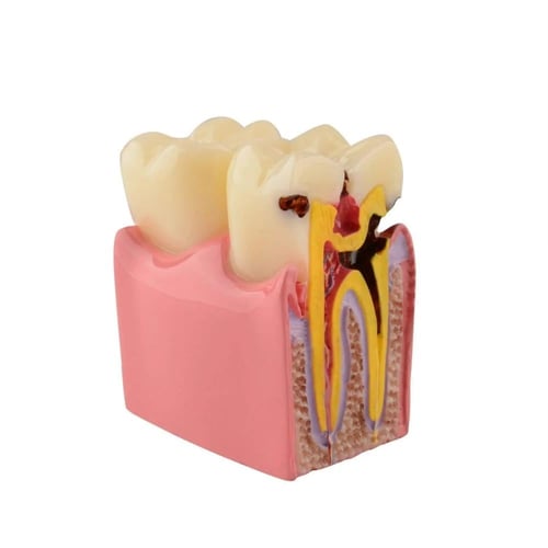 مجسم تسوس الأسنان