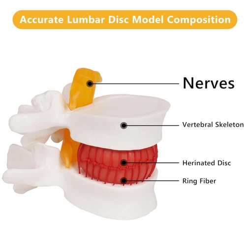 مجسم أمراض الانزلاق الغضروفي الديسك