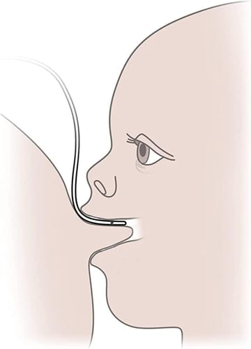 نظام الرضاعة التكميلية SNS