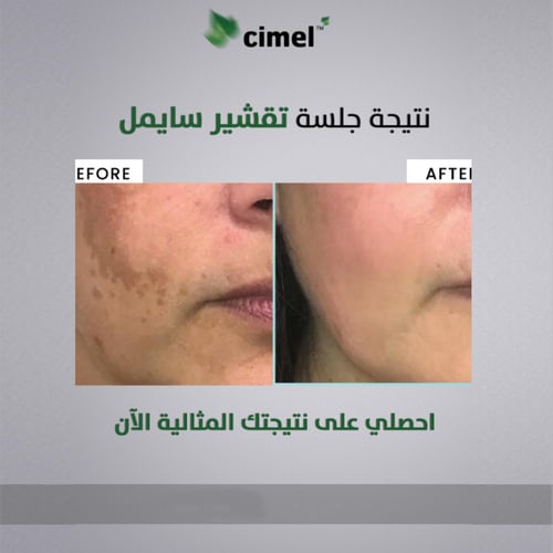 تقشير سايمل