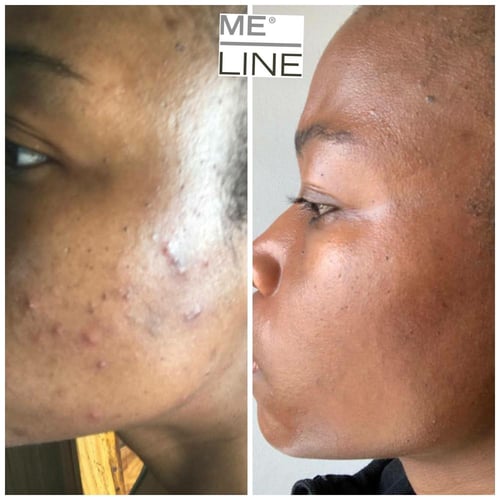 مي لاين 01 كريم تقشير كيميائي للبشرة اثنك سكين Eth...