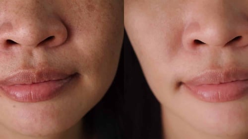 ديرما ميلان – مجموعة التقشير البارد