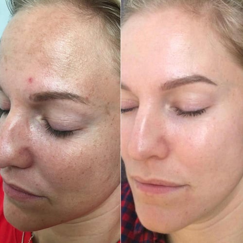 مي لاين 01 كريم تقشير كيميائي للبشرة اثنك سكين Eth...