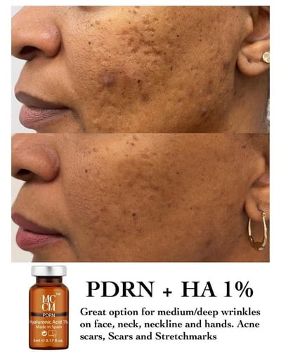 PDRN + HA 1% او 2%HA مكثف الترطيب والتجديد من Skin...