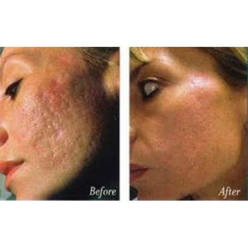 قناع النعناع مع الجلاب لمعالجة حب الشباب من شركة ك...