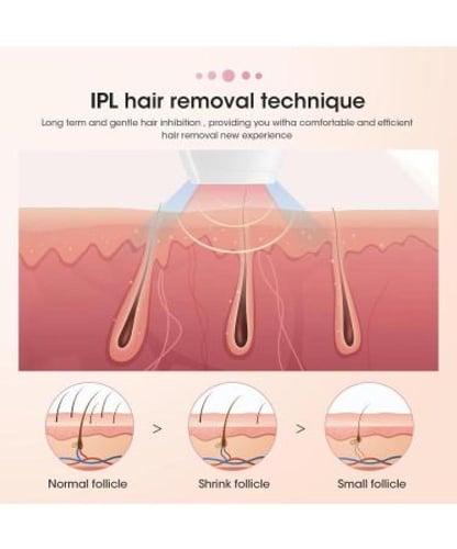 جهاز ليزر لإزالة الشعر من IPL