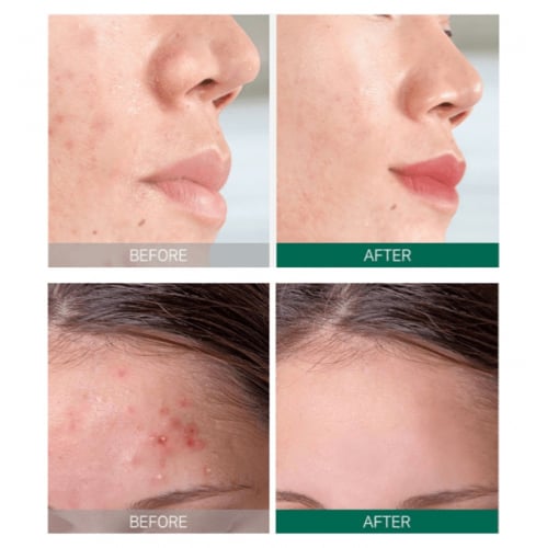 لصقات المعجزة لعلاج حب الشباب والبثور SOME BY MI