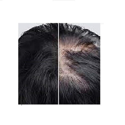 افوجين 5% بخاخ محلول مينوكسيديل لنمو الشعر للرجال...