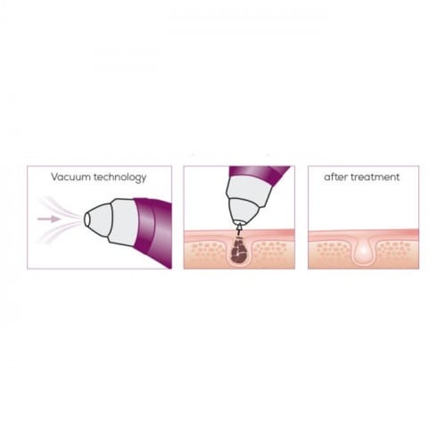 جهاز تنظيف الوجه من بيرور