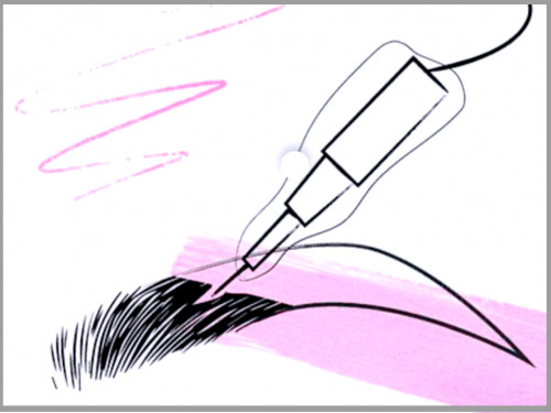 Removal of old tattoo or micro with touch-ups