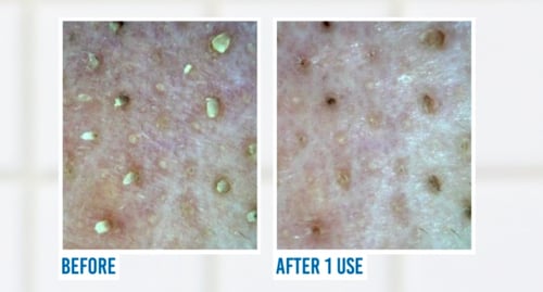 مذوب الرؤوس السوداء والدهون الصلبة في المسام -Jumi...