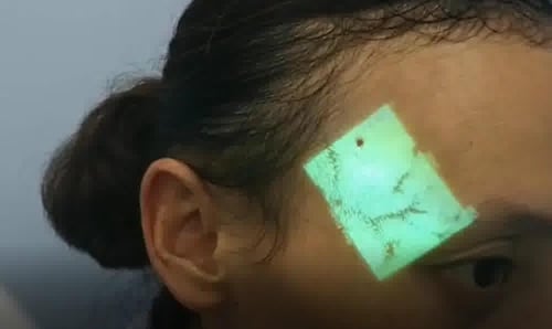 جهاز كاشف الأوردة بالأشعة تحت الحمراء , من كوالميد...