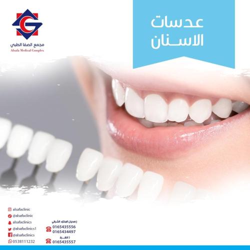 Dental veneers