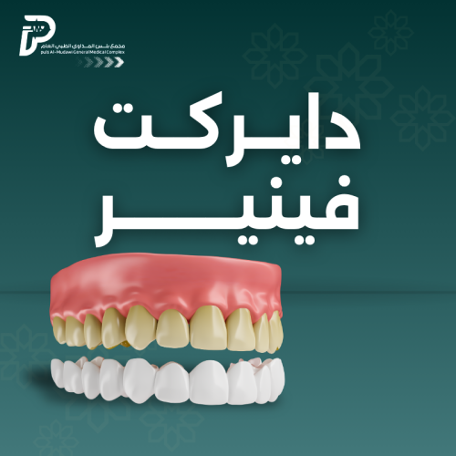 دايركت فينير