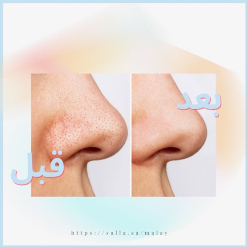 جهاز شفط الرؤوس السوداء بالكاميرا