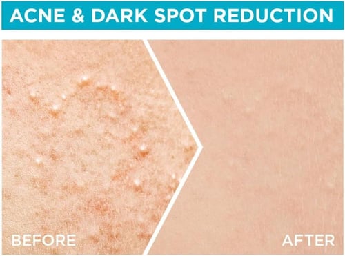 غارنييه سيروم فاست كلير بحمض الساليسيليك 4% لتنقية...