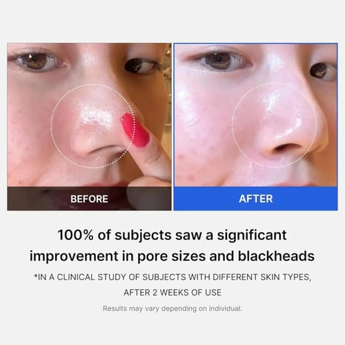 مسحات زيرو بور لتضييق المسام وتنظيف البشرة من ميدي...
