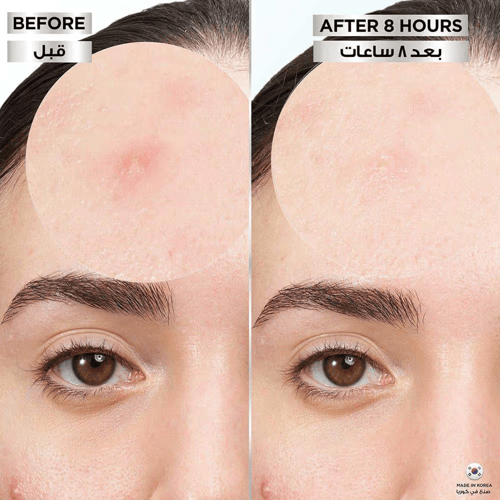 غارنييه لصقات غير المرئية لعلاج البثور - 22 لصقة