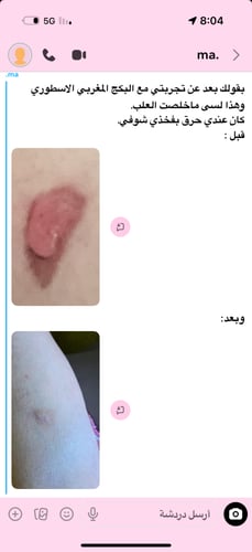 البكج المغربي مع اعشاب الجسم( لحروق الليزر وحروق ا...