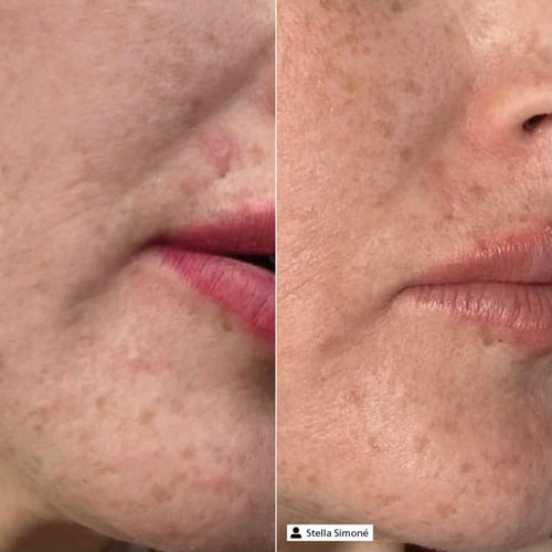 Derma SR Pure Hyaluronic Essence