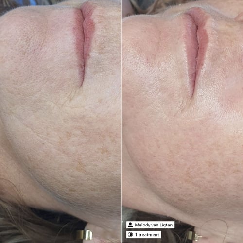 تدريب البشرة الشامل ديرما اس ار