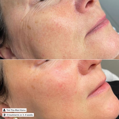 Derma SR Couperose Control Serum