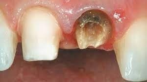 خلع ضرس أو سن متهدم